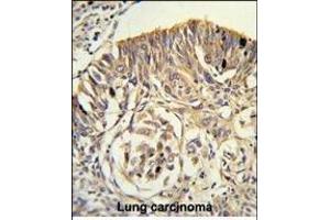 Formalin-fixed and paraffin-embedded human lung carcinoma reacted with PLTP Antibody (C-term), which was peroxidase-conjugated to the secondary antibody, followed by DAB staining. (PLTP anticorps  (C-Term))