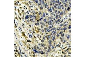 Immunohistochemical analysis of Cytochrome P450 1A1 staining in human esophageal cancer formalin fixed paraffin embedded tissue section. (CYP1A1 anticorps)
