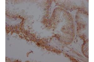 IHC image of ABIN7127366 diluted at 1:100 and staining in paraffin-embedded human prostate cancer performed on a Leica BondTM system. (Recombinant beta 2 Adrenergic Receptor anticorps)
