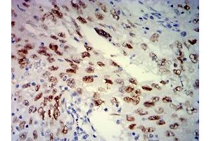 Immunohistochemical analysis of paraffin-embedded lung cancer tissues using MSH6 mouse mAb with DAB staining. (MSH6 anticorps  (AA 374-540))