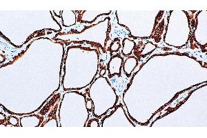 Thyroid, Graves' disease: immunohistochemical staining for Thyroid Peroxidase. (Thyroperoxidase anticorps  (N-Term))