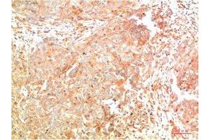 Immunohistochemical analysis of paraffin-embedded Human Breast Carcinoma Tissue using ATG7 Mouse mAb diluted at 1:200. (ATG7 anticorps)