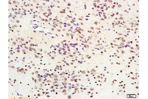Formalin-fixed and paraffin embedded human glioma tissue labeled with Anti-SIRT1 Polyclonal Antibody, Unconjugated (ABIN679028) at 1:200 followed by conjugation to the secondary antibody and DAB staining (SIRT1 anticorps  (AA 551-650))