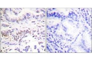 Immunohistochemistry analysis of paraffin-embedded human lung carcinoma tissue, using XRCC3 Antibody. (RCC3 (AA 41-90) anticorps)