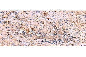 Immunohistochemistry of paraffin-embedded Human cervical cancer tissue using MAPK8IP3 Polyclonal Antibody at dilution of 1:45(x200) (JIP3 anticorps)