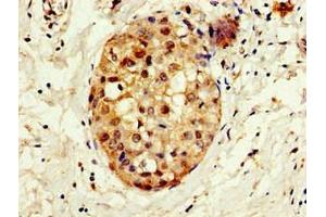 Immunohistochemistry of paraffin-embedded human breast cancer using ABIN7148671 at dilution of 1:100 (CBP anticorps  (AA 2217-2442))