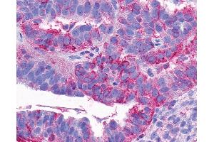 Anti-NTSR2 / NTR2 antibody IHC of human Ovary, Carcinoma. (NTSR2 anticorps  (C-Term))