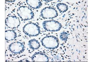 Immunohistochemical staining of paraffin-embedded colon tissue using anti-CHEK2mouse monoclonal antibody. (CHEK2 anticorps)
