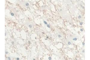 DAB staining on IHC-P; Samples: Human Glioma Tissue) (IL-10 anticorps  (AA 1-178))