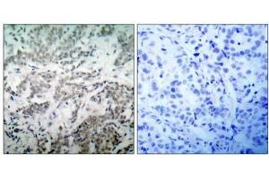 Immunohistochemical analysis of paraffin- embedded human breast carcinoma tissue using BCL-2(Ab-56) antibody (E021059). (Bcl-2 anticorps)