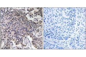 Immunohistochemistry analysis of paraffin-embedded human lung carcinoma tissue, using MRPL54 Antibody. (MRPL54 anticorps  (AA 81-130))