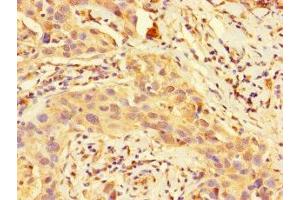 Immunohistochemistry of paraffin-embedded human bladder tissue using ABIN7149795 at dilution of 1:100 (Destrin anticorps  (AA 2-165))