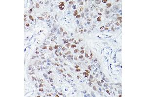 Immunohistochemistry of paraffin-embedded human lung squamous carcinoma tissue using RBPJK Rabbit mAb (ABIN1682563, ABIN3018511, ABIN3018512 and ABIN7101620) at dilution of 1:50 (40x lens). (RBPJ anticorps)