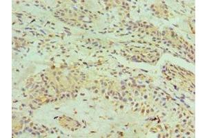 Immunohistochemistry of paraffin-embedded human breast cancer using ABIN7155132 at dilution of 1:100 (HNRNPM anticorps  (AA 491-730))