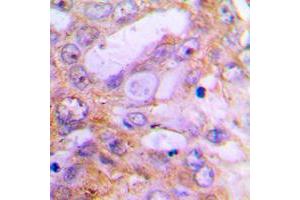 Immunohistochemical analysis of Caspase 12 staining in human lung cancer formalin fixed paraffin embedded tissue section. (Caspase 12 anticorps  (Center))