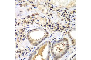 Immunohistochemistry of paraffin-embedded human gastric cancer using PSME2 antibody. (PSME2 anticorps)