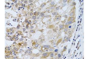 Immunohistochemistry of paraffin-embedded human breast cancer using PHLDA2 antibody (ABIN6292224) at dilution of 1:100 (40x lens). (PHLDA2 anticorps)