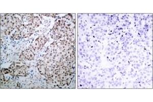 Immunohistochemistry analysis of paraffin-embedded human breast carcinoma, using p53 (Phospho-Ser315) Antibody. (p53 anticorps  (pSer315))