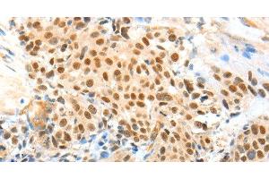 Immunohistochemistry of paraffin-embedded Human esophagus cancer using APPL1 Polyclonal Antibody at dilution of 1:70 (APPL1 anticorps)