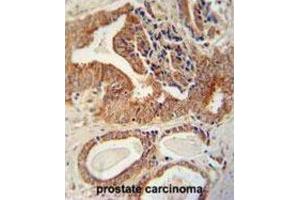 Immunohistochemistry (IHC) image for anti-Insulin-Like Growth Factor 2 mRNA Binding Protein 1 (IGF2BP1) antibody (ABIN2995660) (IGF2BP1 anticorps)