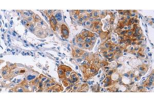 Immunohistochemistry of paraffin-embedded Human lung cancer using CD54 Polyclonal Antibody at dilution of 1:30 (ICAM1 anticorps)