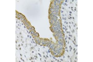Immunohistochemistry of paraffin-embedded human uterine cancer using KRT5 Antibody (ABIN5971441) at dilution of 1/100 (40x lens). (Cytokeratin 5 anticorps)