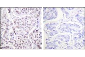 Immunohistochemistry analysis of paraffin-embedded human breast carcinoma tissue, using Histone H4 (Acetyl-Lys5) Antibody. (Histone H4 anticorps  (acLys5))