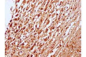 IHC image of ABIN7127796 diluted at 1:100 and staining in paraffin-embedded human melanoma cancer performed on a Leica BondTM system. (Recombinant RNF2 anticorps)