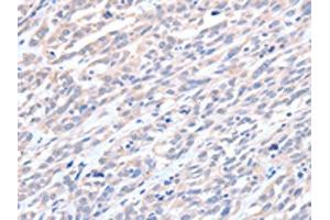 The image on the left is immunohistochemistry of paraffin-embedded Human esophagus cancer tissue using ABIN7128194(ACTL8 Antibody) at dilution 1/15, on the right is treated with fusion protein. (Actin-Like 8 anticorps)