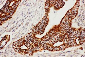 Anti-Secretogranin 3 antibody, IHC(P) IHC(P): Human Rectal Cancer Tissue (SCG3 anticorps  (C-Term))