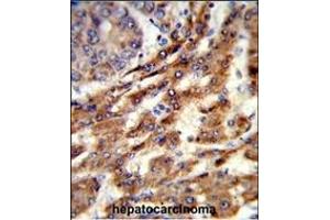 Formalin-fixed and paraffin-embedded human hepatocarcinoma reacted with ERGIC3 Antibody (N-term), which was peroxidase-conjugated to the secondary antibody, followed by DAB staining. (ERGIC3 anticorps  (N-Term))