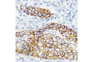 Immunohistochemistry of paraffin-embedded human esophageal cancer using Collagen XVII/COL17 Rabbit mAb (ABIN7266467) at dilution of 1:100 (40x lens). (COL17A1 anticorps)