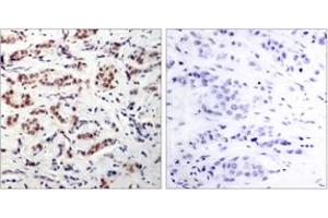 Immunohistochemistry analysis of paraffin-embedded human breast carcinoma, using STAT5A (Phospho-Tyr694) Antibody. (STAT5A anticorps  (pTyr694))