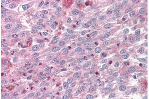 Anti-KLF4 antibody IHC staining of human melanoma. (KLF4 anticorps  (AA 80-129))