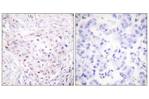 Immunohistochemistry analysis of paraffin-embedded human breast carcinoma tissue, using SENP3 antibody. (SENP3 anticorps  (N-Term))