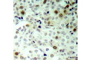 Immunohistochemistry of paraffin-embedded human breast carcinoma using Phospho-CDK2-T160 antibody (ABIN2987938). (CDK2 anticorps  (pThr160))