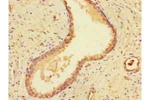 Immunohistochemistry of paraffin-embedded human prostate cancer using ABIN7149795 at dilution of 1:100 (Destrin anticorps  (AA 2-165))