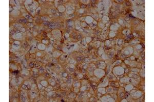 IHC image of ABIN7127636 diluted at 1:100 and staining in paraffin-embedded human liver cancer performed on a Leica BondTM system. (Recombinant N-Cadherin anticorps)
