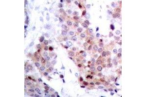 Immunohistochemical analysis of p53 staining in human breast cancer formalin fixed paraffin embedded tissue section. (p53 anticorps)