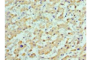 Immunohistochemistry of paraffin-embedded human liver cancer using ABIN7149372 at dilution of 1:100 (ALDH1L1 anticorps  (AA 1-250))