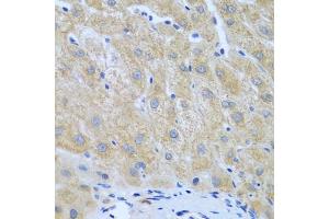 Immunohistochemistry of paraffin-embedded human liver cancer using FURIN antibody (ABIN5974735) at dilution of 1/100 (40x lens). (FURIN anticorps)