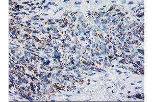 Immunohistochemical staining of paraffin-embedded Adenocarcinoma of Human colon tissue using anti-XPNPEP3 mouse monoclonal antibody. (XPNPEP3 anticorps)