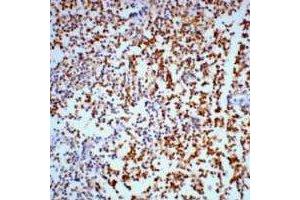 Immunohistochemical analysis of Gamma-enolase staining in human lung cancer formalin fixed paraffin embedded tissue section. (ENO2/NSE anticorps)