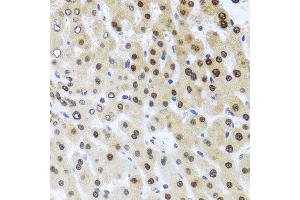 Immunohistochemistry of paraffin-embedded human liver injury using RAD23B antibody. (RAD23B anticorps  (AA 50-150))