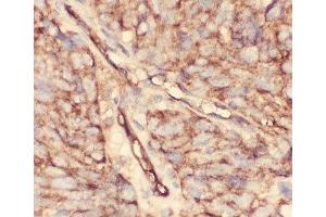 IHC-P: CD34 antibody testing of human lung cancer tissue (CD34 anticorps  (AA 151-385))