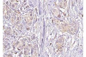 ABIN6274630 at 1/100 staining Human breast cancer tissue by IHC-P. (COX17 anticorps  (N-Term))