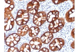 Formalin-fixed, paraffin-embedded human Colon Carcinoma stained with EpCAM Mouse Recombinant Monoclonal Antibody (rMOC-31). (Recombinant EpCAM anticorps)