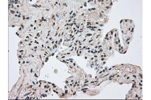 Immunohistochemical staining of paraffin-embedded Adenocarcinoma of breast tissue using anti-FERMT2 mouse monoclonal antibody. (FERMT2 anticorps)