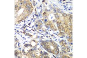 Immunohistochemistry of paraffin-embedded human gastric cancer using CDK1 antibody (ABIN6134274, ABIN6138303, ABIN6138304 and ABIN6219543) at dilution of 1:100 (40x lens). (CDK1 anticorps  (AA 208-258))