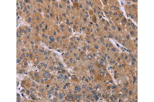 Immunohistochemistry of Human liver cancer using PPIF Polyclonal Antibody at dilution of 1:45 (PPIF anticorps)